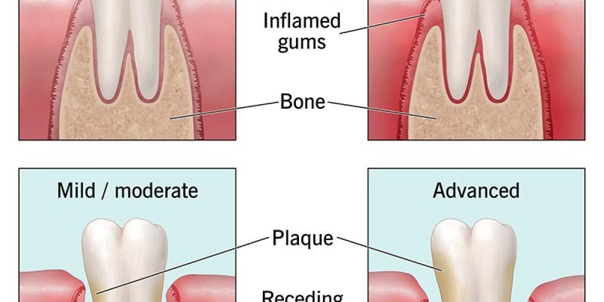 The Connection Between Periodontitis and Overall Health